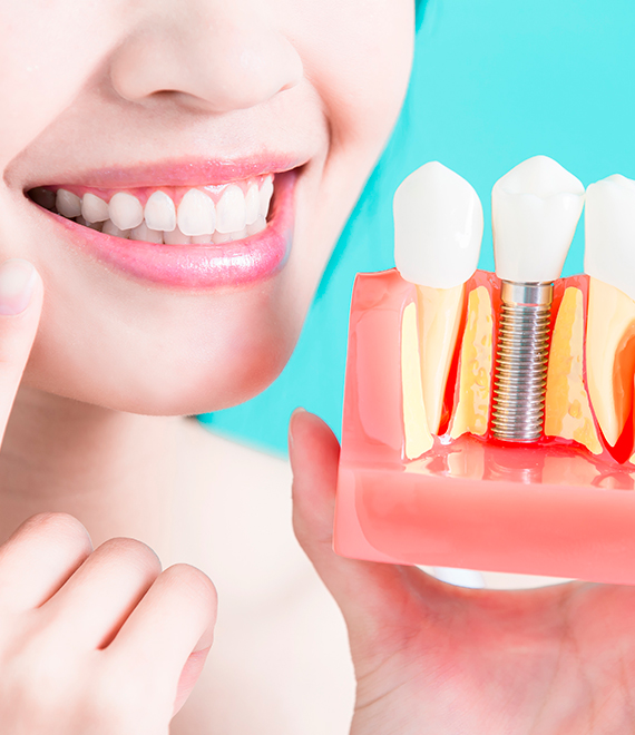 dental-implants-1